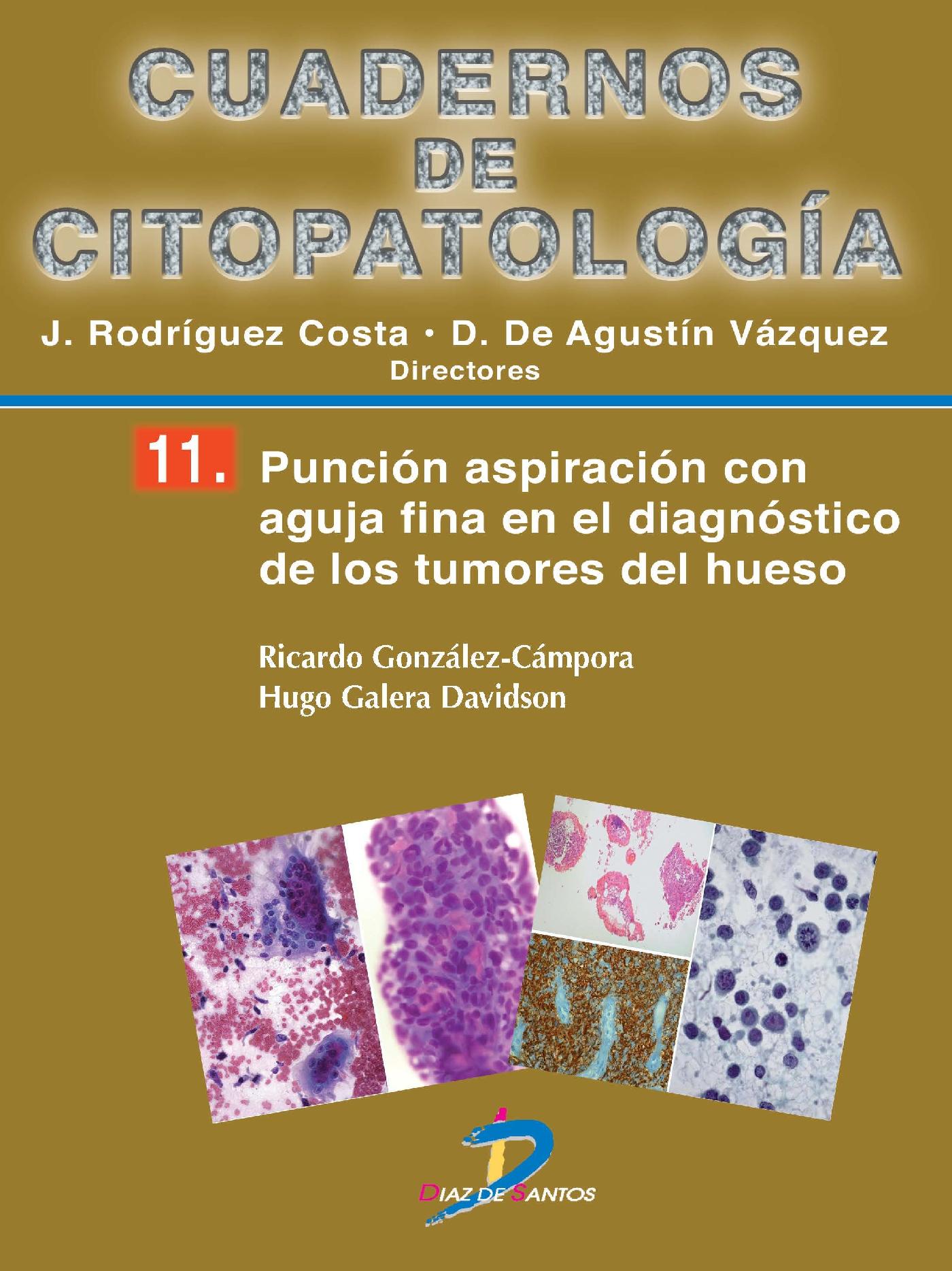 PUNCIÓN ASPIRACIÓN CON AGUJA FINA EN EL DIAGNÓSTICO DE LOS TUMORES DE HUESO