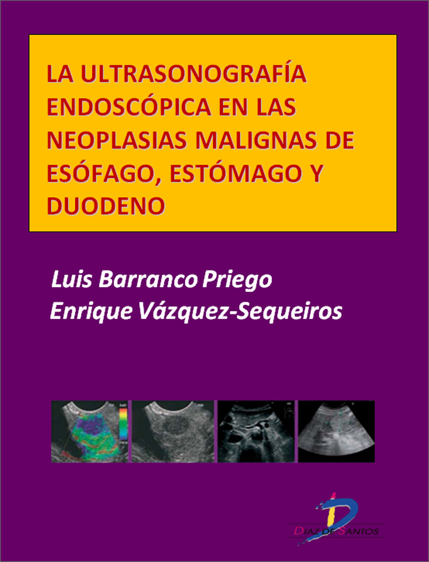 LA ULTRASONOGRAFÍA ENDOSCÓPICA EN LAS NEOPLASIAS MALIGNAS DE ESÓFAGO, ESTÓMAGO Y DUODENO